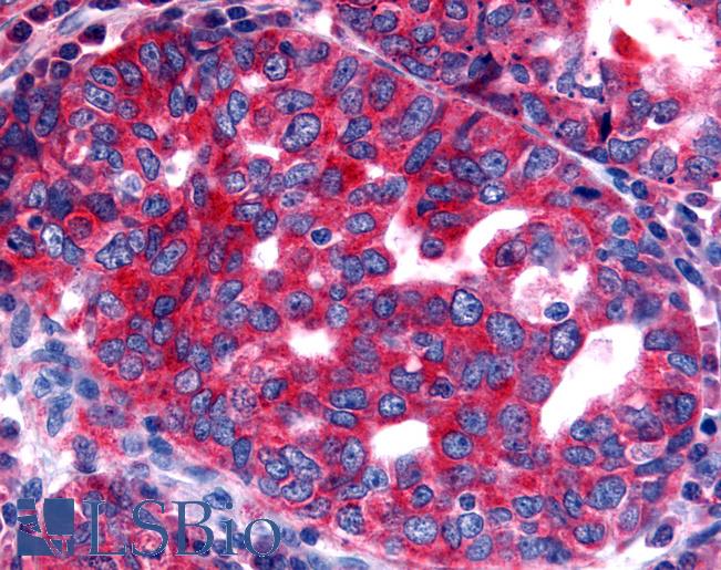 Anti-NTSR2 / NTR2 antibody IHC of human Ovary, Carcinoma. Immunohistochemistry of formalin-fixed, paraffin-embedded tissue after heat-induced antigen retrieval.