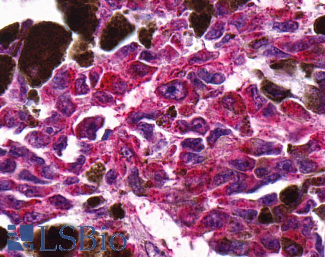 Anti-NTSR2 / NTR2 antibody IHC of human Skin, Melanoma. Immunohistochemistry of formalin-fixed, paraffin-embedded tissue after heat-induced antigen retrieval.