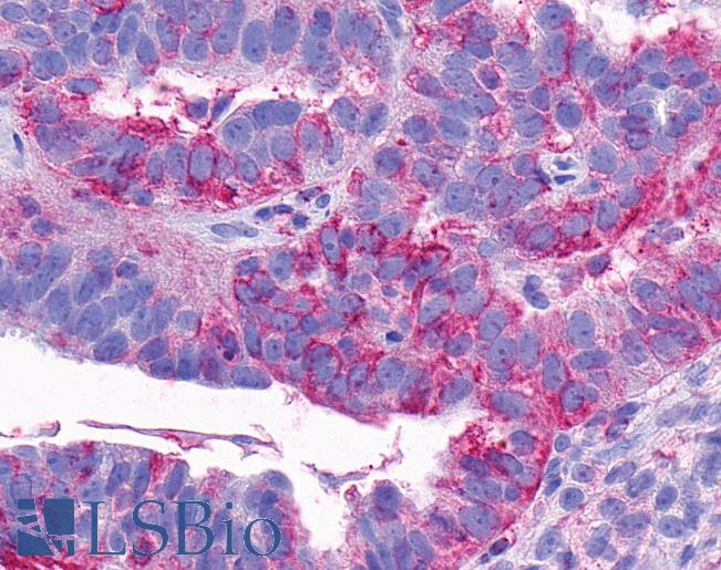 Anti-NTSR2 / NTR2 antibody IHC of human Ovary, Carcinoma. Immunohistochemistry of formalin-fixed, paraffin-embedded tissue after heat-induced antigen retrieval.