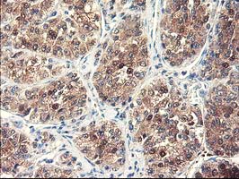 IHC of paraffin-embedded Carcinoma of Human liver tissue using anti-NUBPL mouse monoclonal antibody. (Heat-induced epitope retrieval by 10mM citric buffer, pH6.0, 100C for 10min).