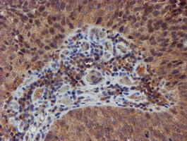 IHC of paraffin-embedded Carcinoma of Human bladder tissue using anti-NUBPL mouse monoclonal antibody. (Heat-induced epitope retrieval by 10mM citric buffer, pH6.0, 100C for 10min).