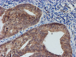 IHC of paraffin-embedded Adenocarcinoma of Human endometrium tissue using anti-NUBPL mouse monoclonal antibody. (Heat-induced epitope retrieval by 10mM citric buffer, pH6.0, 100C for 10min).