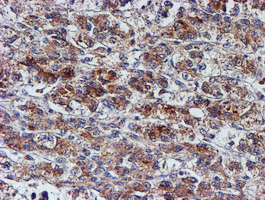 IHC of paraffin-embedded Carcinoma of Human liver tissue using anti-NUBPL mouse monoclonal antibody. (Heat-induced epitope retrieval by 10mM citric buffer, pH6.0, 100C for 10min).