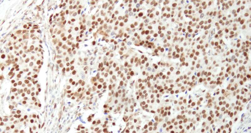 Detection of Human NUCKS by Immunohistochemistry. Sample: FFPE section of human breast carcinoma. Antibody: Affinity purified rabbit anti-NUCKS used at a dilution of 1:1000 (1 ug/ml). Detection: DAB.