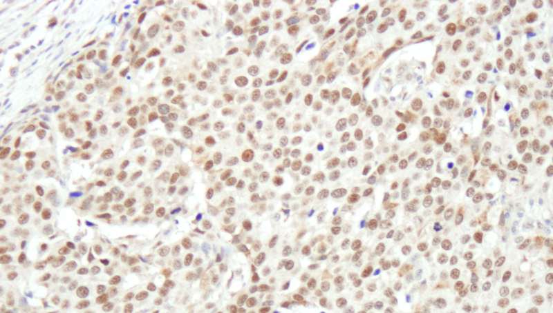 Detection of Human NUCKS by Immunohistochemistry. Sample: FFPE section of human breast carcinoma. Antibody: Affinity purified rabbit anti-NUCKS used at a dilution of 1:1000 (1 ug/ml). Detection: DAB.