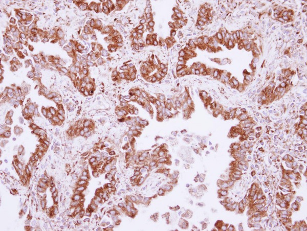 IHC of paraffin-embedded Lung ADCA, using CML66 antibody at 1:500 dilution.