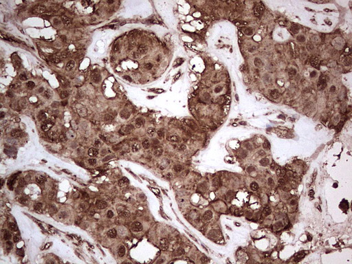IHC of paraffin-embedded Carcinoma of Human liver tissue using anti-NUDT12 mouse monoclonal antibody. (Heat-induced epitope retrieval by 1 mM EDTA in 10mM Tris, pH8.5, 120°C for 3min).