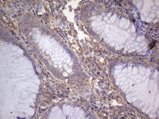 IHC of paraffin-embedded Adenocarcinoma of Human colon tissue using anti-NUDT12 mouse monoclonal antibody. (Heat-induced epitope retrieval by 1 mM EDTA in 10mM Tris, pH8.5, 120°C for 3min).