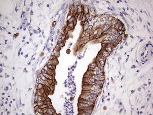 IHC of paraffin-embedded Carcinoma of Human pancreas tissue using anti-NUDT12 mouse monoclonal antibody. (Heat-induced epitope retrieval by 1 mM EDTA in 10mM Tris, pH8.5, 120°C for 3min).