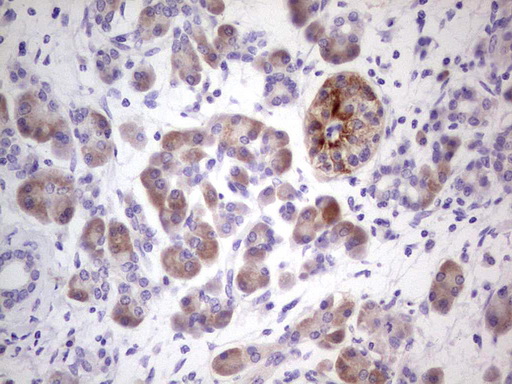 IHC of paraffin-embedded Carcinoma of Human pancreas tissue using anti-NUDT12 mouse monoclonal antibody. (Heat-induced epitope retrieval by 1 mM EDTA in 10mM Tris, pH8.5, 120°C for 3min).