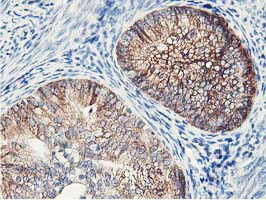IHC of paraffin-embedded Adenocarcinoma of Human endometrium tissue using anti-NUDT18 mouse monoclonal antibody.