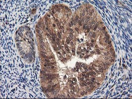 IHC of paraffin-embedded Adenocarcinoma of Human endometrium tissue using anti-NUDT18 mouse monoclonal antibody.
