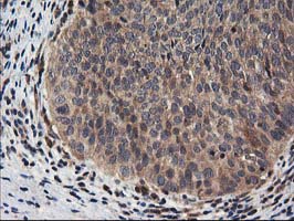 IHC of paraffin-embedded Carcinoma of Human bladder tissue using anti-NUDT18 mouse monoclonal antibody.