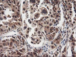 IHC of paraffin-embedded Carcinoma of Human lung tissue using anti-NUDT18 mouse monoclonal antibody.