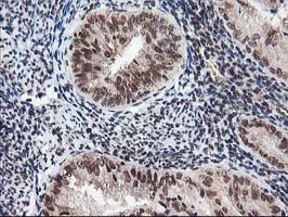 IHC of paraffin-embedded Adenocarcinoma of Human endometrium tissue using anti-NUDT18 mouse monoclonal antibody.