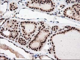 IHC of paraffin-embedded Carcinoma of Human thyroid tissue using anti-NUDT18 mouse monoclonal antibody.
