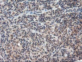 IHC of paraffin-embedded Human lymphoma tissue using anti-NUDT18 mouse monoclonal antibody.