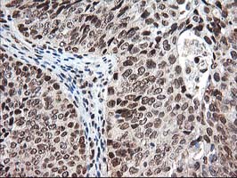 IHC of paraffin-embedded Carcinoma of Human bladder tissue using anti-NUDT18 mouse monoclonal antibody.
