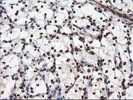 IHC of paraffin-embedded Carcinoma of Human kidney tissue using anti-NUDT18 mouse monoclonal antibody.