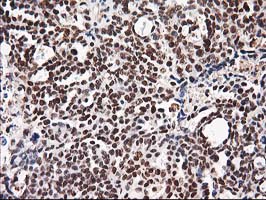 IHC of paraffin-embedded Adenocarcinoma of Human ovary tissue using anti-NUDT18 mouse monoclonal antibody.