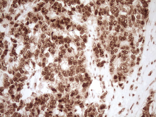 IHC of paraffin-embedded Adenocarcinoma of Human endometrium tissue using anti-NUDT21 mouse monoclonal antibody. (Heat-induced epitope retrieval by 1 mM EDTA in 10mM Tris, pH8.5, 120°C for 3min).