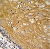 NUDT22 Antibody immunohistochemistry of formalin-fixed and paraffin-embedded human esophageal carcinoma followed by peroxidase-conjugated secondary antibody and DAB staining.