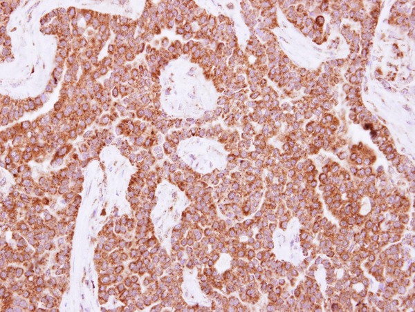 IHC of paraffin-embedded Lung AdCA, using NUDT3 antibody at 1:500 dilution.