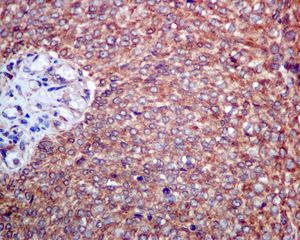 IHC of paraffin-embedded human bladder carcinoma tissue using anti-NUDT5 antibody.