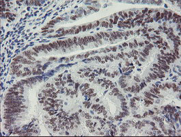 IHC of paraffin-embedded Adenocarcinoma of Human endometrium tissue using anti-MEIS3 mouse monoclonal antibody. (Heat-induced epitope retrieval by 10mM citric buffer, pH6.0, 100C for 10min).