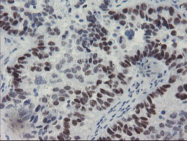 IHC of paraffin-embedded Adenocarcinoma of Human ovary tissue using anti-MEIS3 mouse monoclonal antibody. (Heat-induced epitope retrieval by 10mM citric buffer, pH6.0, 100C for 10min).