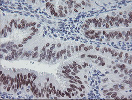 IHC of paraffin-embedded Adenocarcinoma of Human endometrium tissue using anti-MEIS3 mouse monoclonal antibody.