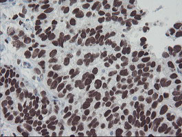 IHC of paraffin-embedded Adenocarcinoma of Human ovary tissue using anti-MEIS3 mouse monoclonal antibody.