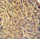 NUP210 Antibody immunohistochemistry of formalin-fixed and paraffin-embedded human lung carcinoma followed by peroxidase-conjugated secondary antibody and DAB staining.