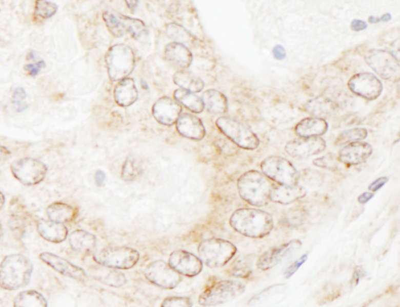 Detection of Human NUP35 by Immunohistochemistry. Sample: FFPE section of human prostate carcinoma. Antibody: Affinity purified rabbit anti-NUP35 used at a dilution of 1:1000 (1 ug/ml). Detection: DAB.