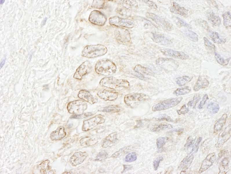 Detection of Human NUP35 by Immunohistochemistry. Sample: FFPE section of human prostate-nodular hypertrophy. Antibody: Affinity purified rabbit anti-NUP35 used at a dilution of 1:250.