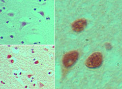 IHC of NUP35 in formalin-fixed, paraffin-embedded human brain tissue using an isotype control (top left) and LS-C148601 (bottom left, right) at 5 ug/ml.