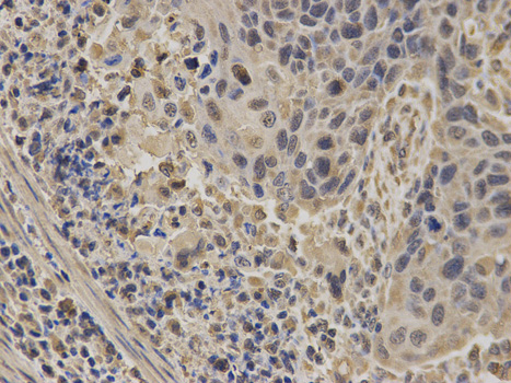 Immunohistochemistry of paraffin-embedded human esophageal cancer using NUP62 antibody at dilution of 1:100 (400x lens).