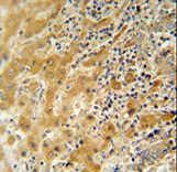 NUSAP antibody immunohistochemistry of formalin-fixed and paraffin-embedded human hepatocarcinoma followed by peroxidase-conjugated secondary antibody and DAB staining.