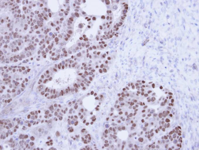 IHC of paraffin-embedded NCIN87 Xenograft using TAP antibody at 1:100 dilution.