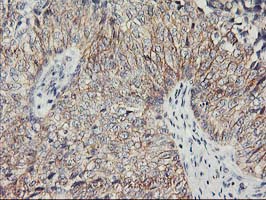 IHC of paraffin-embedded Carcinoma of Human bladder tissue using anti-PVRL1 mouse monoclonal antibody.