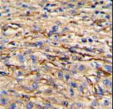 Formalin-fixed and paraffin-embedded human hepatocarcinoma reacted with Nestin Antibody (S1409), which was peroxidase-conjugated to the secondary antibody, followed by DAB staining. This data demonstrates the use of this antibody for immunohistochemistry; clinical relevance has not been evaluated.