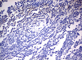 IHC of paraffin-embedded Human lymphoma tissue using anti-OAS2 mouse monoclonal antibody. (Heat-induced epitope retrieval by 10mM citric buffer, pH6.0, 120°C for 3min).