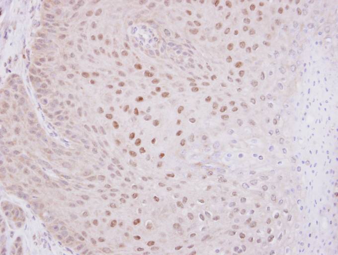 IHC of paraffin-embedded Cal27 Xenograft using O-GlcNAc transferase antibody at 1:100 dilution.