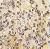 Formalin-fixed and paraffin-embedded human prostate carcinoma tissue reacted with MEN1 Antibody (T594) , which was peroxidase-conjugated to the secondary antibody, followed by DAB staining. This data demonstrates the use of this antibody for immunohistochemistry; clinical relevance has not been evaluated.