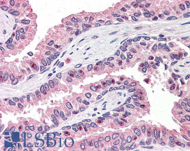 Anti-OLFM4 antibody LS-A8455 IHC of human prostate. Immunohistochemistry of formalin-fixed, paraffin-embedded tissue after heat-induced antigen retrieval.