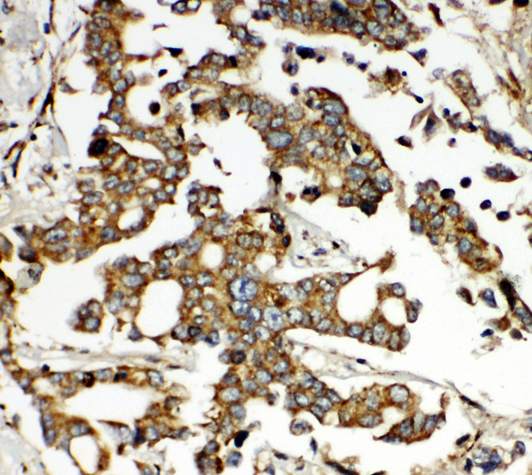 ONECUT1 / HNF6 antibody. IHC(P): Human Liver Cancer Tissue.