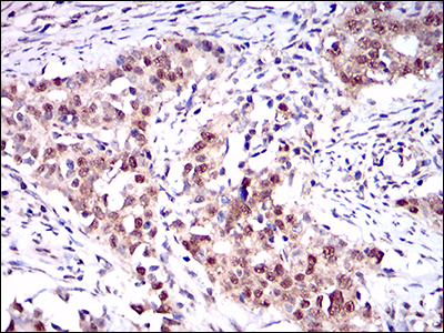 IHC of paraffin-embedded cervical cancer tissues using ONECUT3 mouse monoclonal antibody with DAB staining.