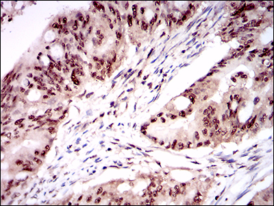 IHC of paraffin-embedded rectum cancer tissues using ONECUT3 mouse monoclonal antibody with DAB staining.