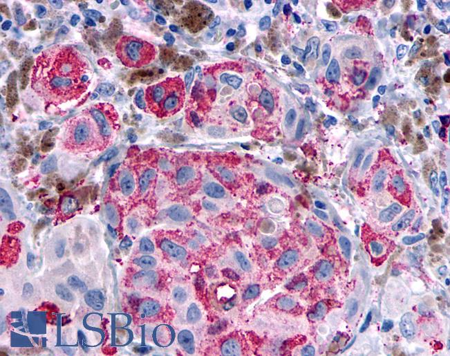 Anti-OPRD1 / Delta Opioid Receptor antibody IHC of human Skin, Melanoma. Immunohistochemistry of formalin-fixed, paraffin-embedded tissue after heat-induced antigen retrieval.