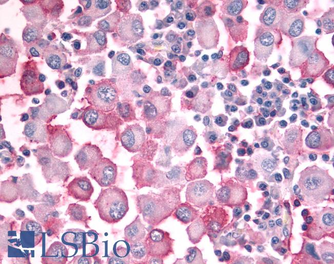 Anti-OR10J5 antibody IHC of human Skin, Melanoma. Immunohistochemistry of formalin-fixed, paraffin-embedded tissue after heat-induced antigen retrieval.
